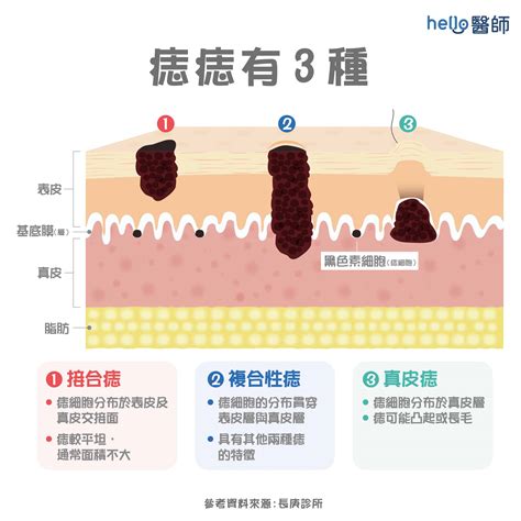 多痣的原因